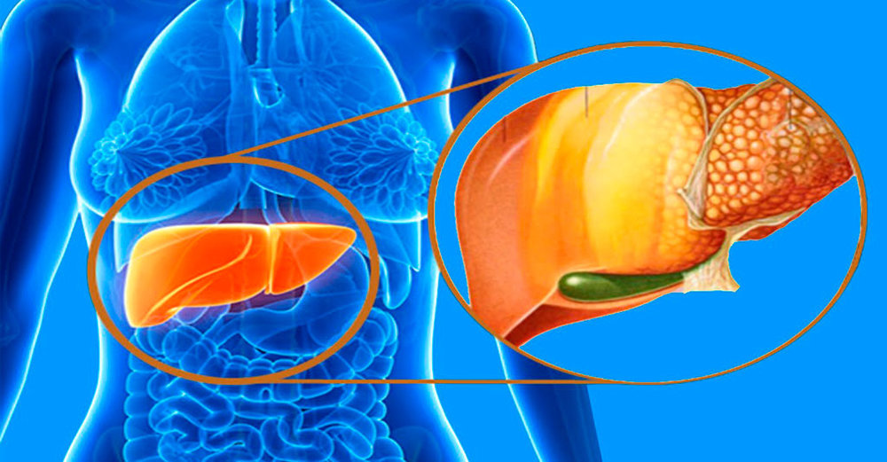 علائم انواع کبد چرب را بشناسید+ راهکار درمان در طب‌ سنتی