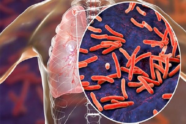 سل همچنان در صدر کشنده‌ترین بیماری‌های عفونی جهان