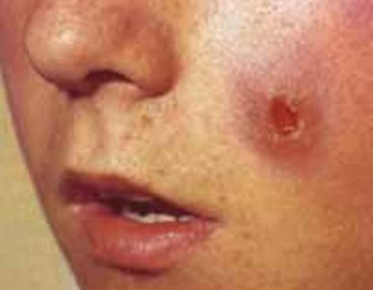 بایدها و نبایدهای بیماری سالک