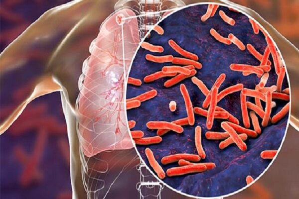 بیماری سل چیست و چرا هنوز مهم است؟ | ایران در مسیر حذف بیماری سل + بررسی آمار و چالشها 1 بیماری سل چیست و چرا هنوز مهم است؟ | ایران در مسیر حذف بیماری سل + بررسی آمار و چالشها