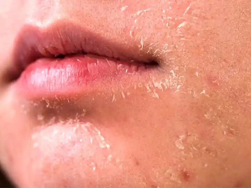 خشکی پوست در پاییز + علت، علائم و راه های پیشگیری 1 خشکی پوست در پاییز + علت، علائم و راه های پیشگیری