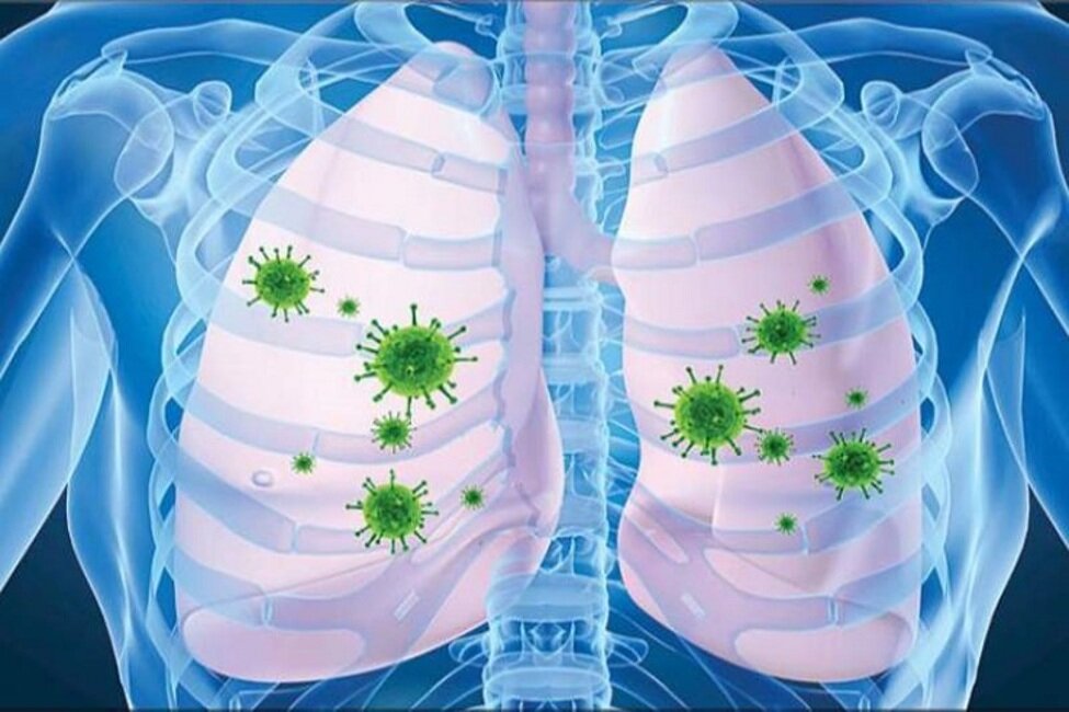 ذات‌الریه یا پنیومونی چیست؟ | علائم، علل و روش‌های درمانی برای پیشگیری و بهبودی سریع