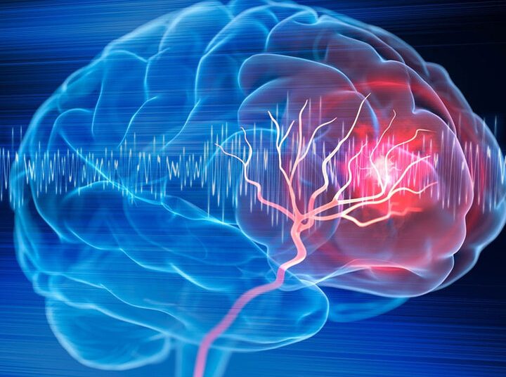 سالانه ۱۵۰ هزار نفر در کشور دچار سکته مغزی می‌شوند