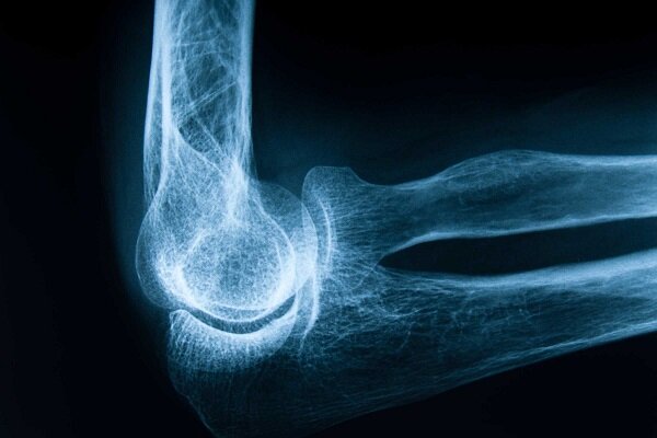 پوکی استخوان؛ نبردی بیصدا در معماری بدن 1 پوکی استخوان؛ نبردی بیصدا در معماری بدن