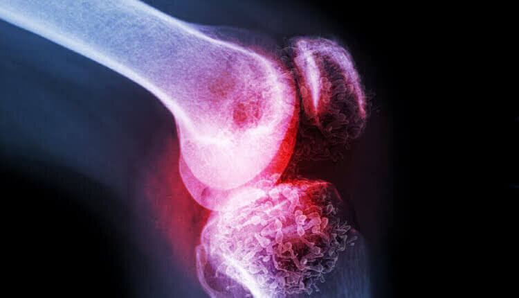 پوکی استخوان؛ نبردی بیصدا در معماری بدن 3 پوکی استخوان؛ نبردی بیصدا در معماری بدن