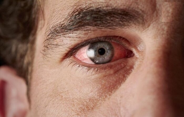 آب سیاه چشم چیست و چه علائمی دارد؟ / فشار چشم ارتباطی با فشار خون سیستمیک ندارد 2 آب سیاه چشم چیست و چه علائمی دارد؟ / فشار چشم ارتباطی با فشار خون سیستمیک ندارد